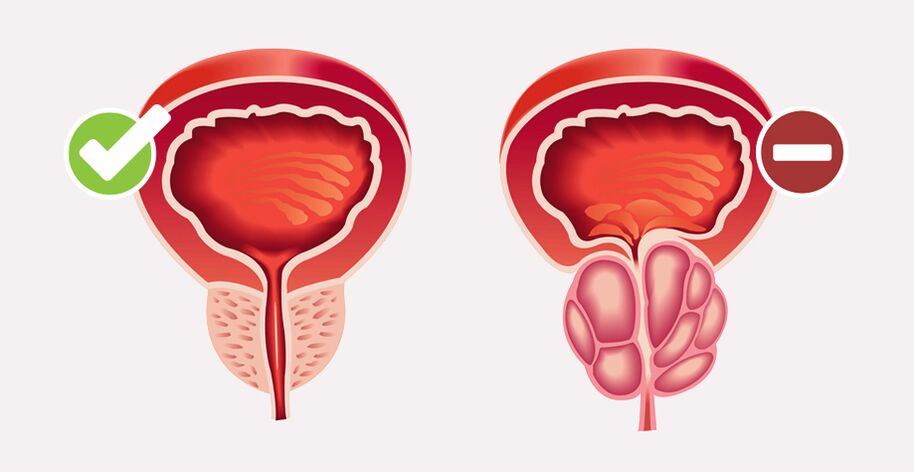 Weiprost normalise la taille et la fonction de la prostate