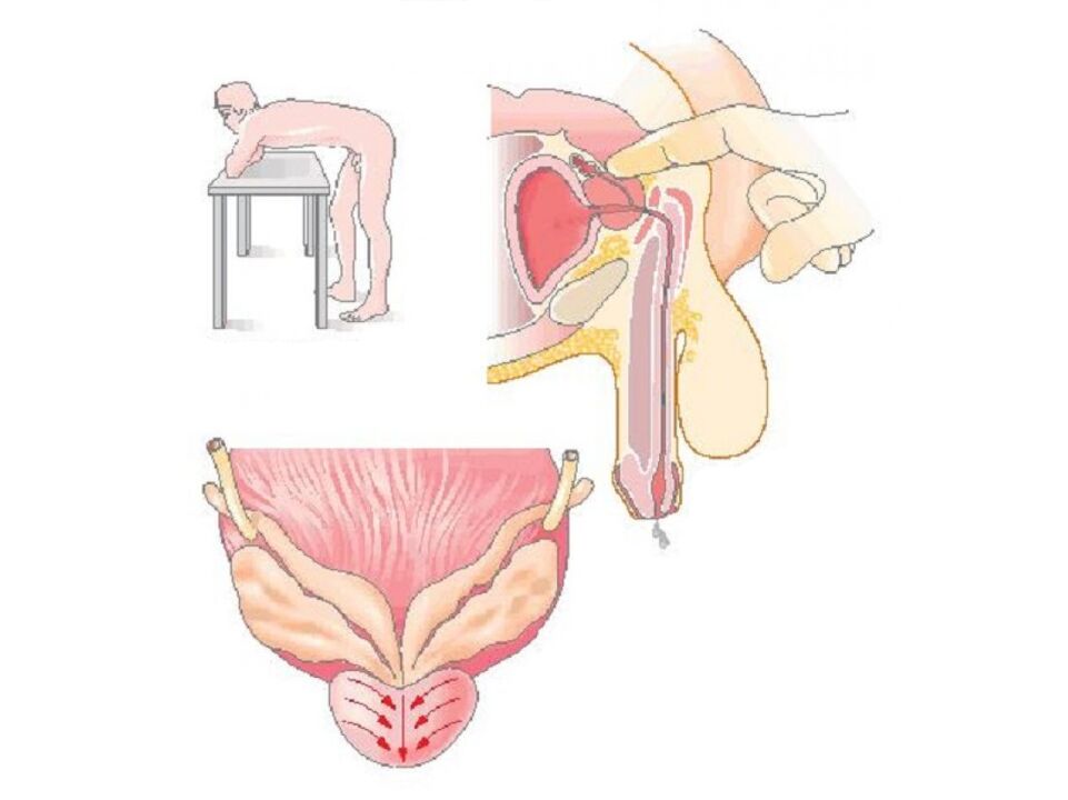 Technique de massage de la prostate par un médecin pour faire une analyse de la sécrétion